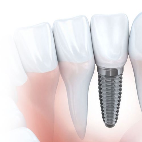 ทำฟัน ขอนแก่น ราคา